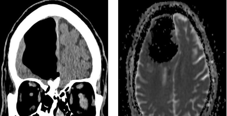 L'anomalia nel cervello di un irlandese ha colpito i medici