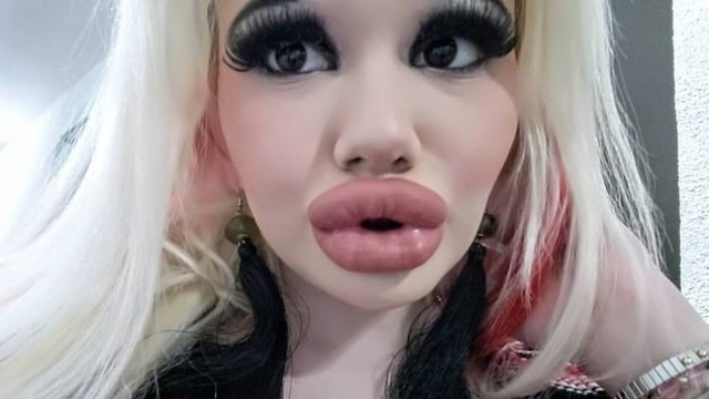 Una studentessa bulgara alla ricerca della moda ha triplicato le sue labbra