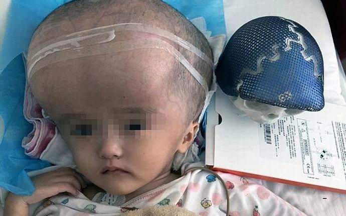 Un teschio stampato su una stampante è stato inizialmente impiantato in un uomo.