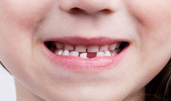 è possibile conservare i denti da latte presagio 