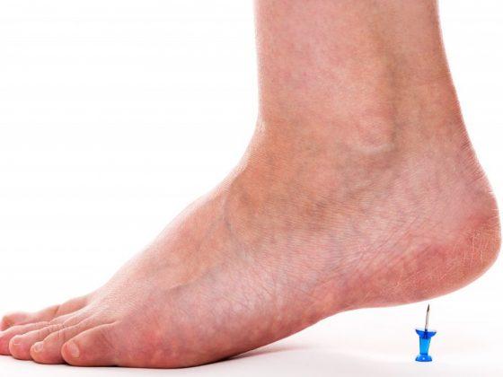 cospirazione dello sperone calcaneare 