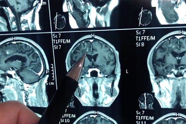 Un uomo cinese ha vissuto per 30 anni con un enorme verme in testa.