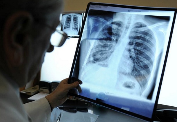 Una donna cinese ha rotto dieci costole a causa di un forte attacco di tosse: la colpa è della crema solare