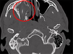 Il tedesco visse per 15 anni con una matita in testa