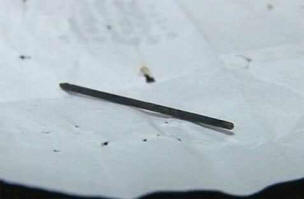 L'ago per agopuntura ha viaggiato attraverso il corpo di un uomo di 40 anni