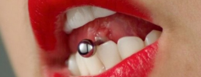 Ha trafitto la lingua - ha perso i denti anteriori