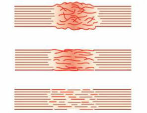 Con l'aiuto di un manico biologico, qualsiasi danno ai tessuti può essere curato rapidamente.
