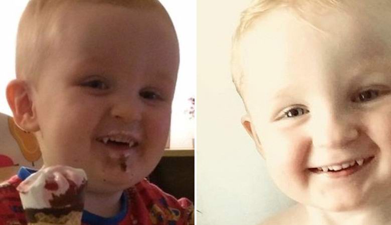 Un ragazzo inglese ha avuto improvvisamente le zanne