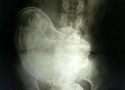 In Brasile, una donna di 44 anni portava con sé un bambino morto.