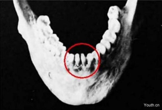 Un teschio con strani denti è stato trovato in Cina