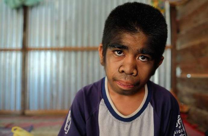 Un ragazzo peloso con la sindrome di un lupo mannaro rifiuta il trattamento