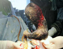 I medici hanno tirato fuori quattro chilogrammi di capelli da una ragazza aspirapolvere